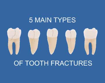 general dentistry fractured tooth